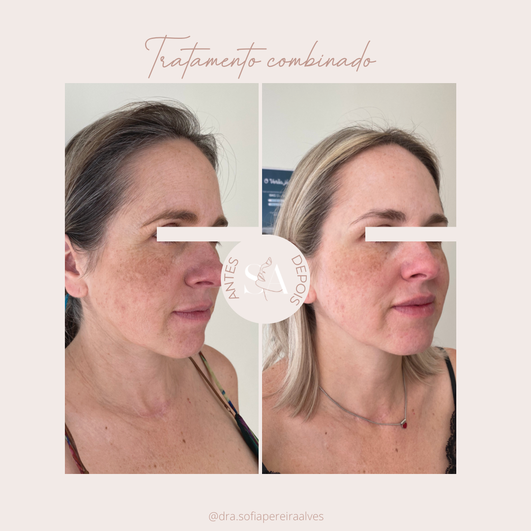 tratamento combinaado.PNG