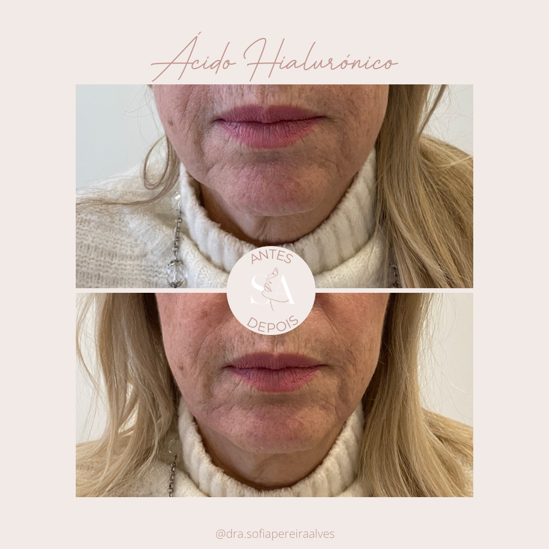 acido hialuronicoo.PNG