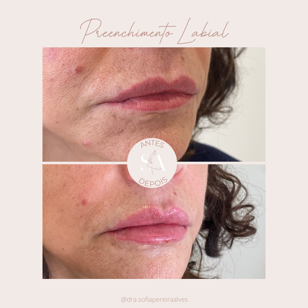 Antes e depois preenchimento_labial.PNG