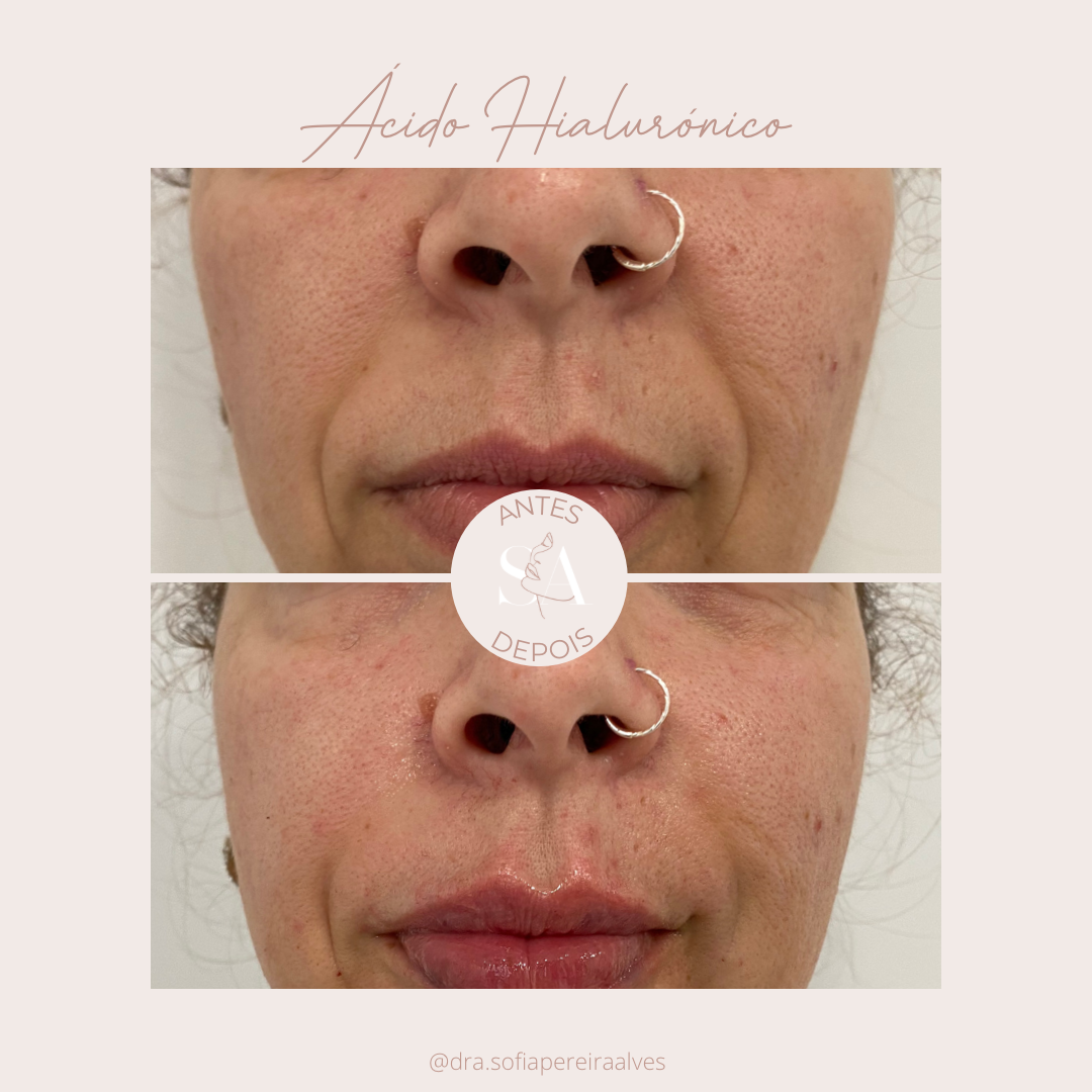 Acido Hialuronico.PNG