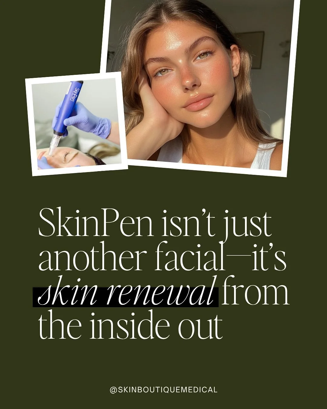 ✨Microneedling with SkinPen✨
Your skin&rsquo;s glow-up starts here! 💫

SkinPen creates tiny micro-channels in the skin to stimulate collagen and elastin&mdash;leaving you with smoother texture, refined pores, and that radiant, healthy glow. 🌟

Perf