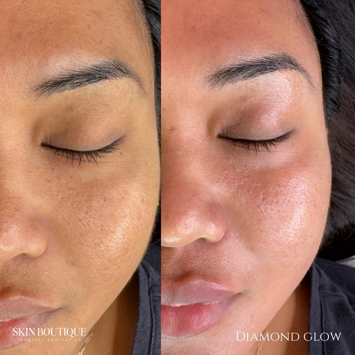 So excited to share our newest treatment! The DiamondGlow facial is finally here and I seriously can&rsquo;t wait for you to try it! 💖

Please excuse the lighting in this pic, but look at that glow and how plump her skin looks! ✨

We treated her fac