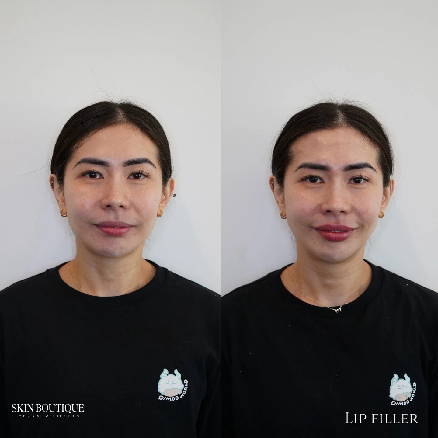👄 The results speak for themselves! Our lip filler enhances your natural shape for a subtle, balanced, and confidence-boosting look.

💬 Comment LIPS below to get a personalized quote or book your consultation today!

📍 4747 Katella Avenue Suite 10