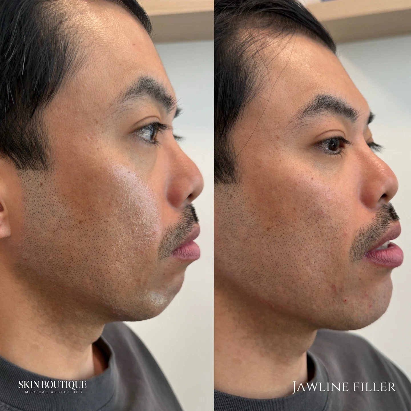 This patient came in wanting to look more refreshed and less tired. During our consultation, I noticed some mid-face volume loss, which was contributing to a tired appearance and creating imbalance in the lower face.

My goal was to restore structure