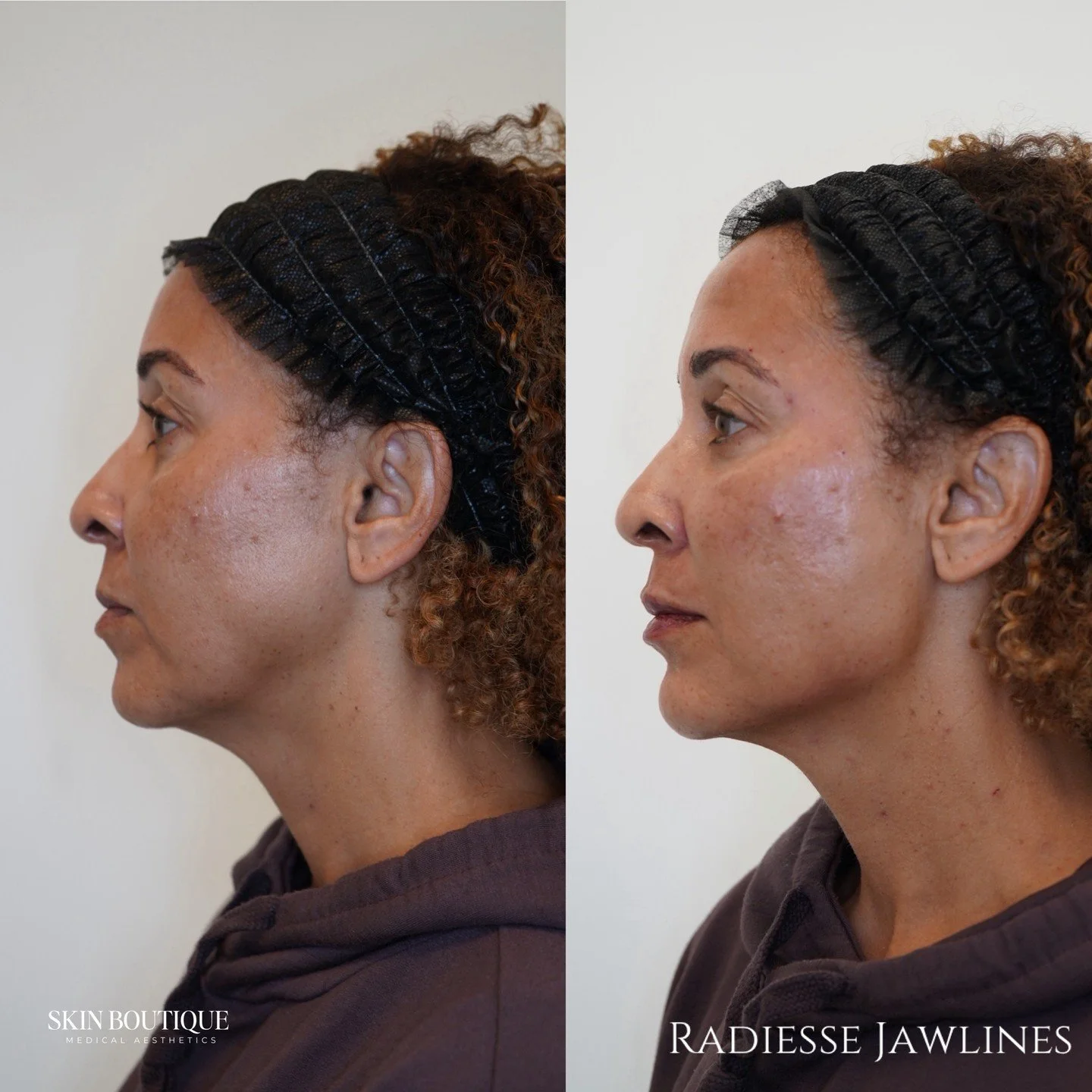 Swipe to see how Radiesse can redefine and sculpt the jawline ✨
This patient came in wanting:
/01 A more defined jawline
/02 Smoother, contoured lower face
/03 Subtle lift for a natural, balanced profile

Radiesse isn&rsquo;t just filler &mdash; it s