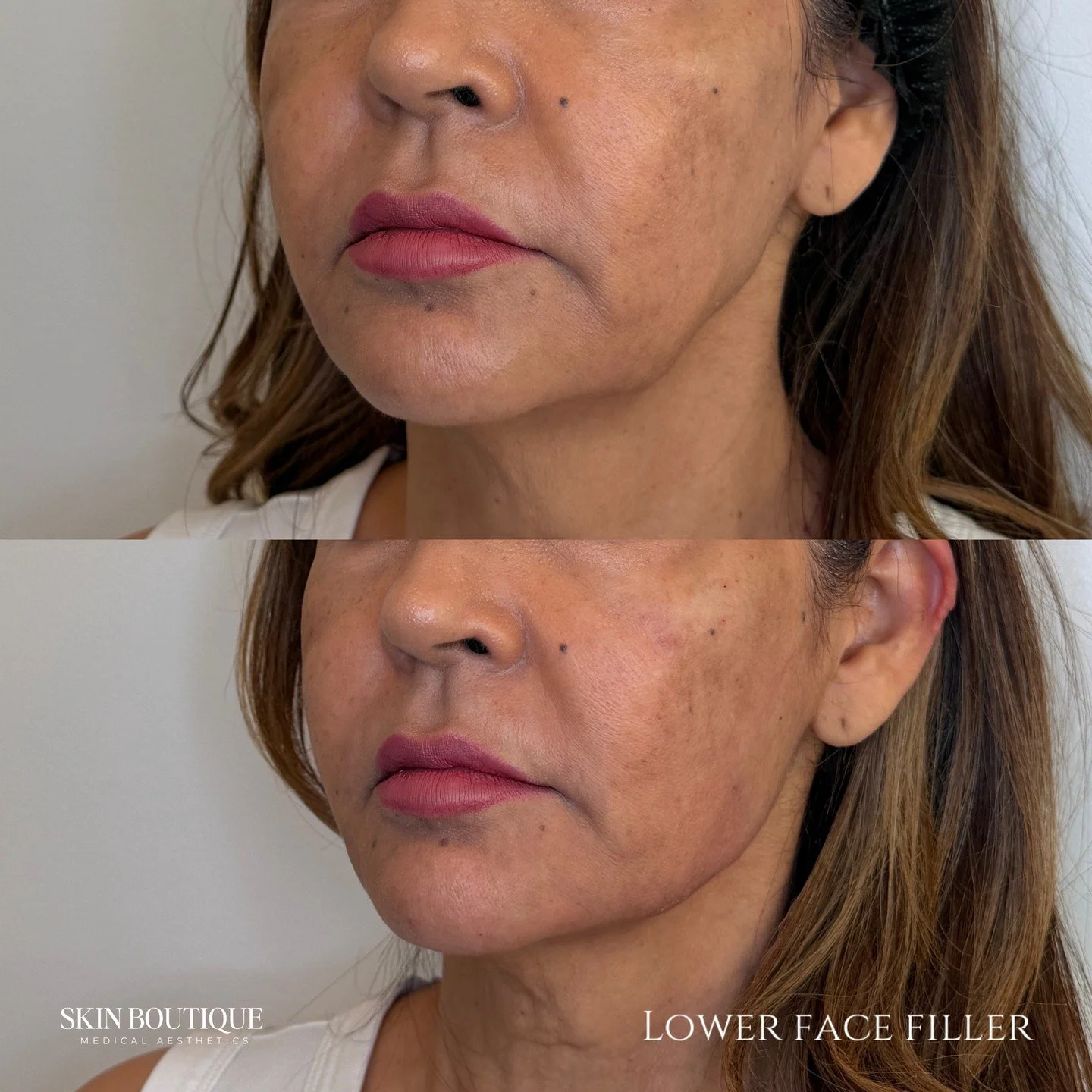 subtle lifting appearance. smoother lines. balanced lower face. ✨

swipe to see how strategic lower face filler restores structure, softens folds, and creates a more youthful, harmonious profile.

this treatment is perfect for:
&mdash; marionette lin