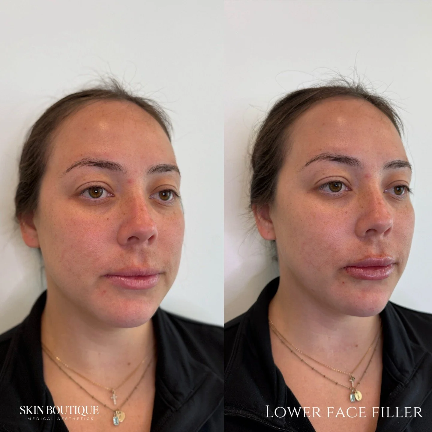 Swipe to see the transformation -- 

This patient wanted a more defined jawline, lips hydration, &amp; lower face support &mdash; and our dermal filler treatments delivered natural, balanced results.
We customize every treatment to enhance your uniqu