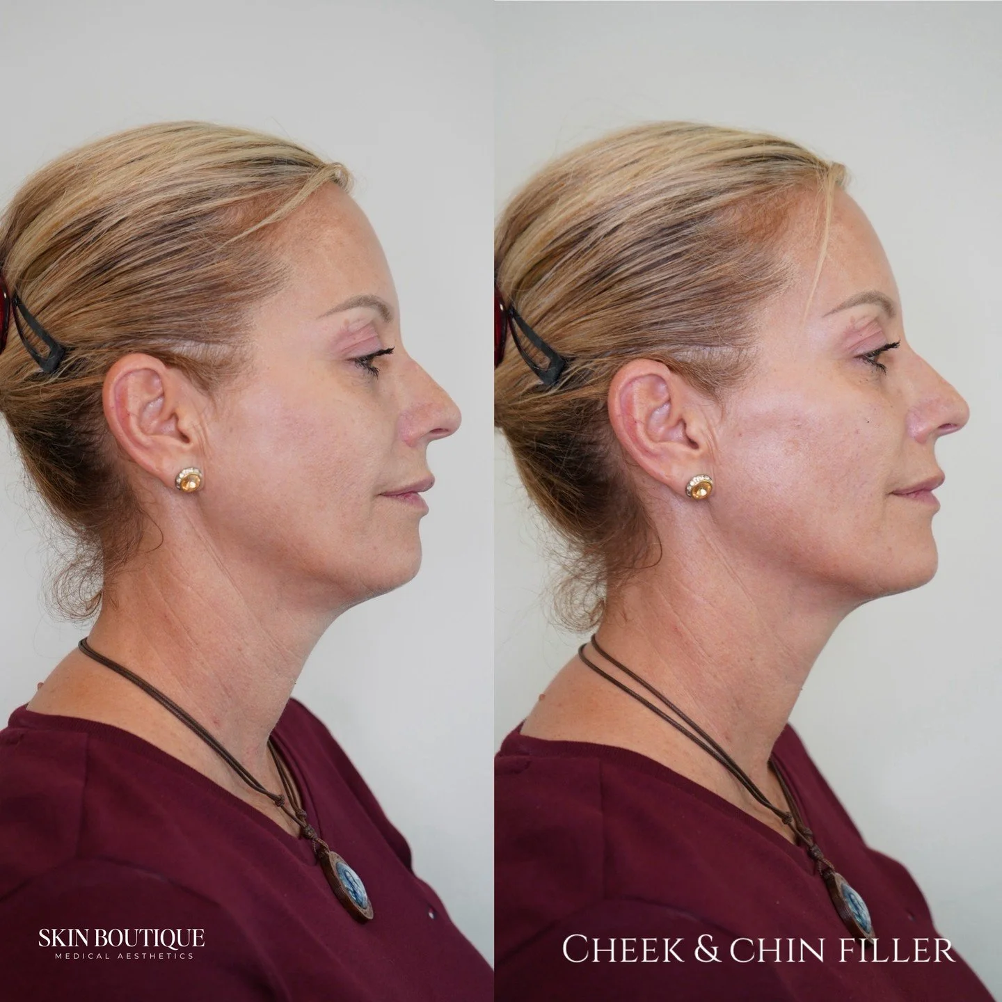 ✨ Small changes, big impact! ✨
This beautiful patient came in wanting a more defined jawline and subtle rejuvenation.

During her assessment, I noticed a bit of mid-face volume loss and a need for just a sprinkle of support to the chin for better pro