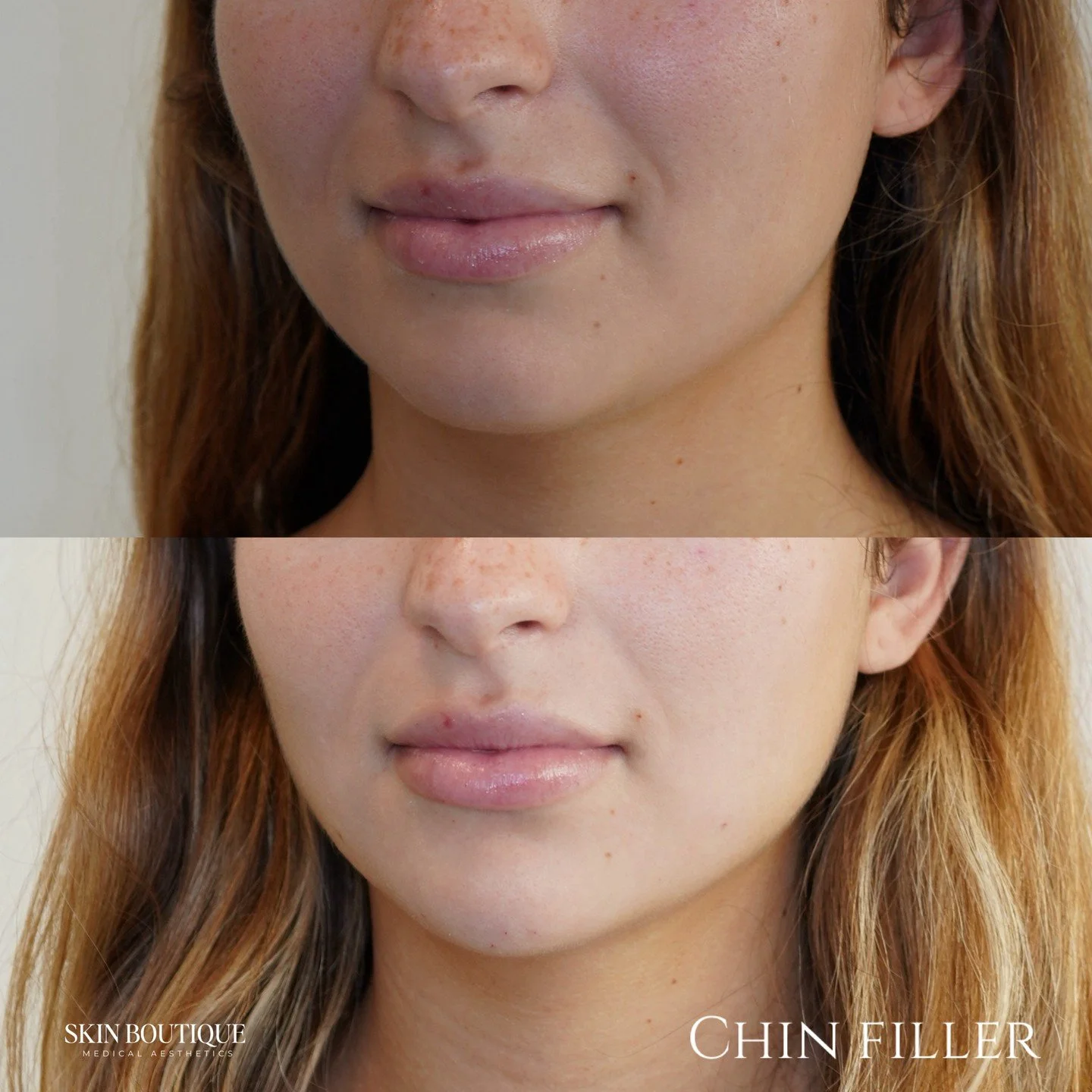 ✨ The most underrated area to treat? The CHIN ✨

A little chin support can completely transform facial balance &mdash; sharper jawline, better profile, and a more defined lower face&hellip; without looking overdone.

It&rsquo;s not about a &ldquo;big