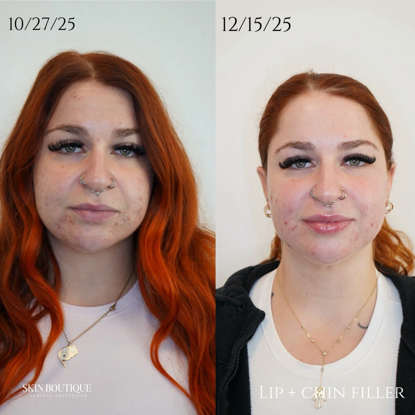 ✨ Another subtle changes, big impact ✨

This patient came in requesting more definition and hydration. I suggested balancing her lower face with chin + chin shadow filler &mdash; and voil&agrave; ✨ instant harmony and structure.

PS: Her skin is also