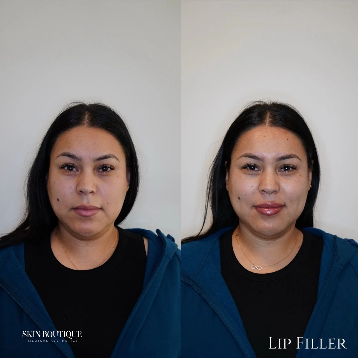 ✨ Not everyone is a lip filler candidate ✨
⠀⠀⠀⠀⠀⠀⠀⠀⠀
When you come see me for lip filler, I don&rsquo;t just look at your lips &mdash; I look at your entire face.
My goal is to make sure enhancing your lips will support your facial harmony, not disru