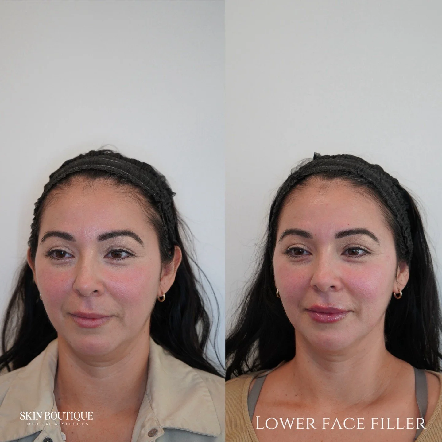 Facial balancing is rooted in proportion, structure, and harmony- not treating isolated areas.

When addressing the lower face, I often evaluate the lips, chin, chin shadow, and jawline together, because these structures work as a unit. Subtle suppor