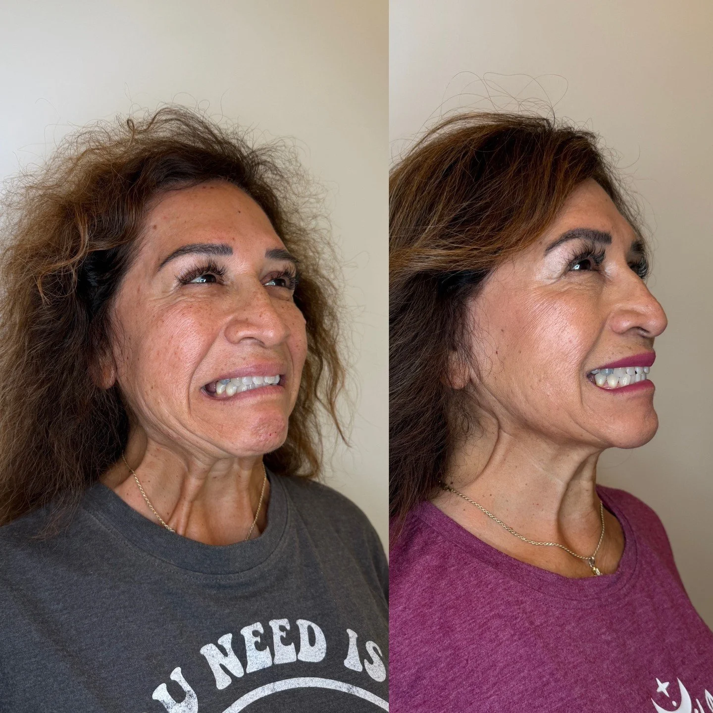 If you&rsquo;ve been following me for a while, you know one of my favorite areas to treat with tox is the Nefertiti Neck Lift ✨

By carefully relaxing specific muscles in the neck and jawline, we can create a smoother neckline, improved jaw definitio