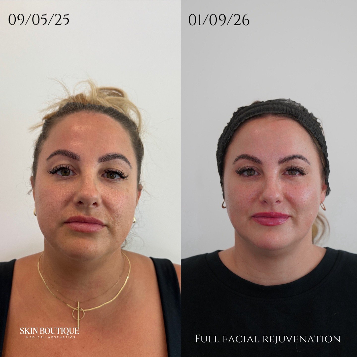 This beautiful patient is all about collagen banking + skin quality. She also wanted her lips a little more plump &mdash;
But of course, I don&rsquo;t just treat lips 💉

I always assess the face as a whole. She needed subtle support in the lower fac