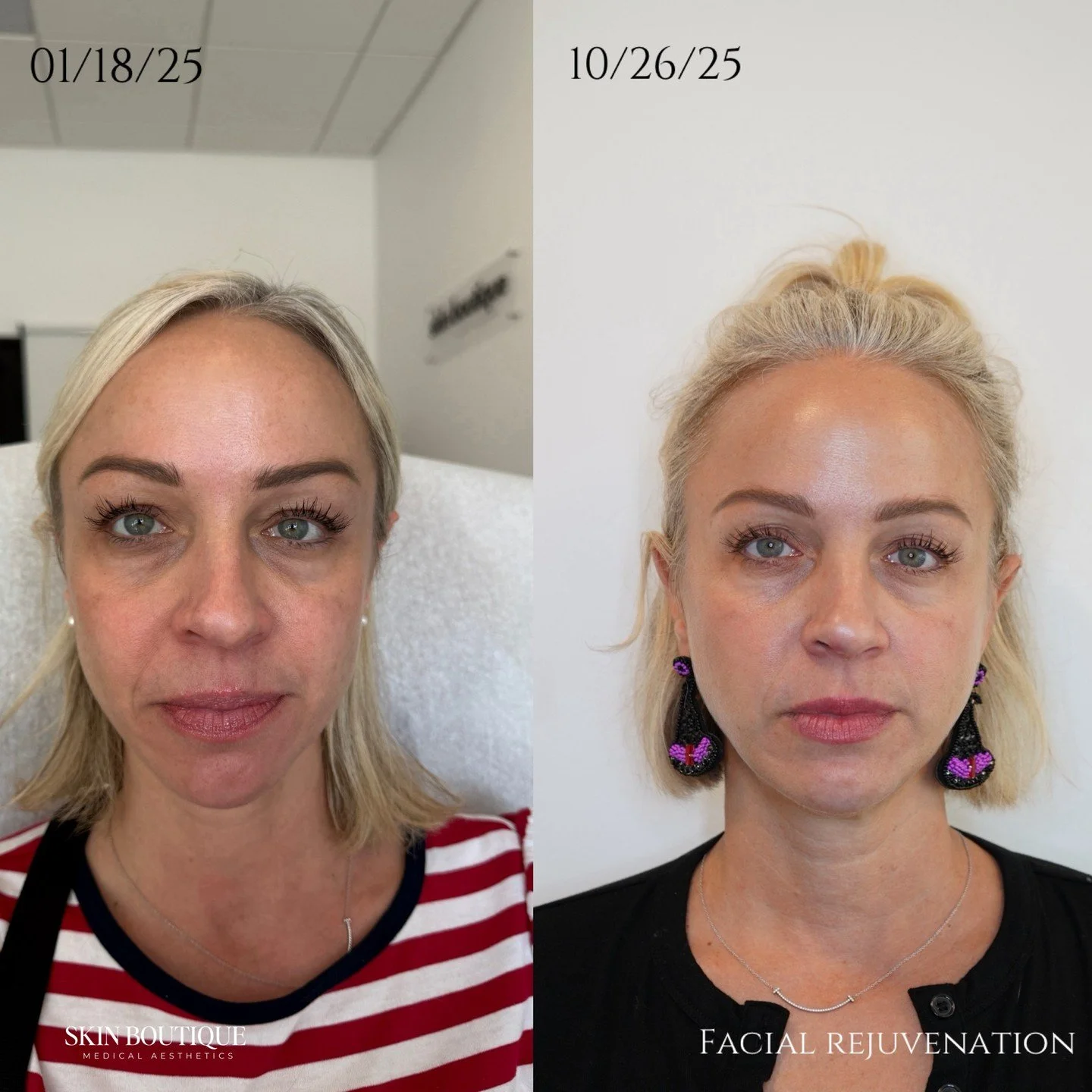 This beautiful patient came to me wanting to look less tired and more refreshed &mdash; not different.

At Skin Boutique, we don&rsquo;t chase overnight miracles that leave you looking like someone else. We focus on true facial rejuvenation. ✨

This 