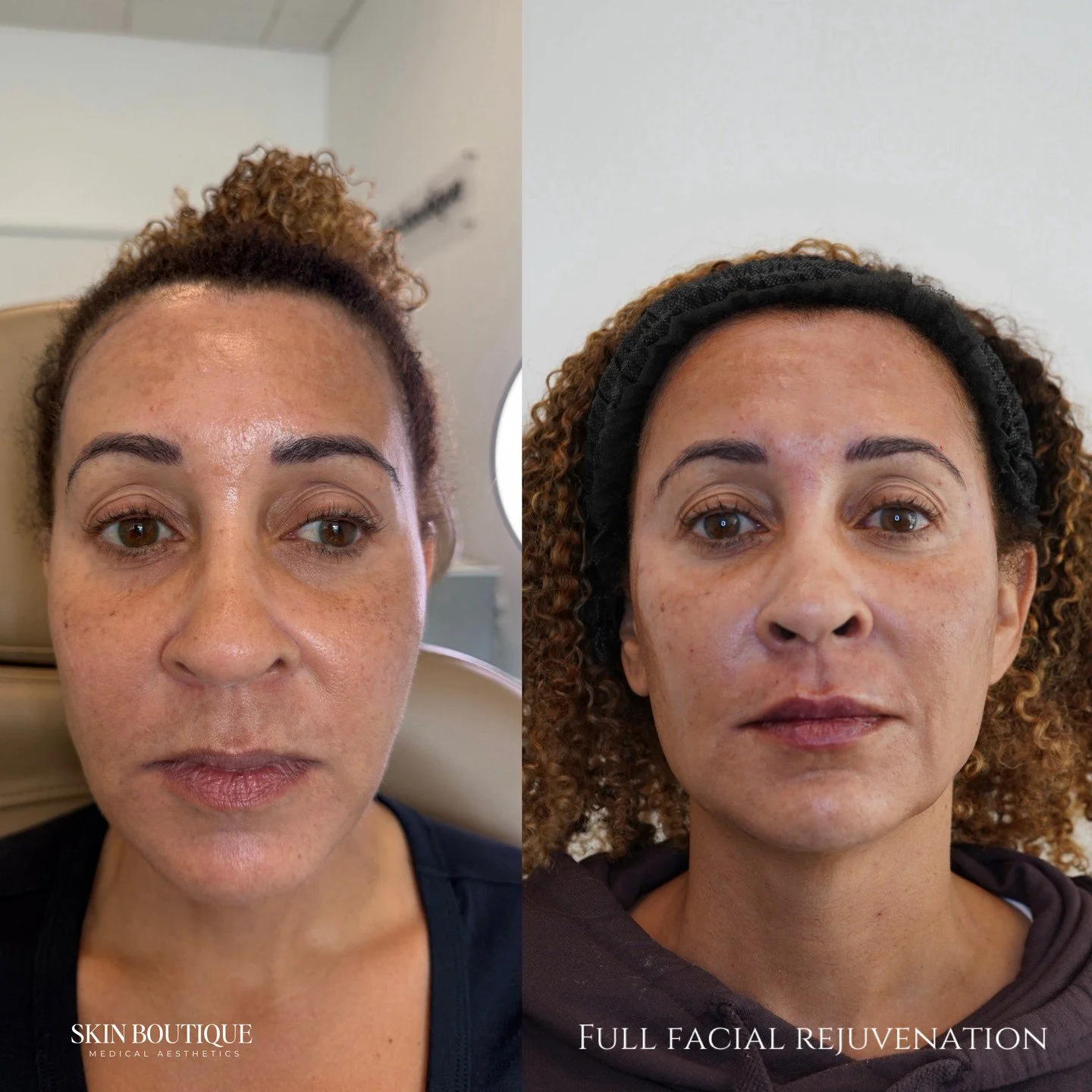 This transformation has to be one of my favorites. ✨

This beautiful patient trusted me and allowed me to guide the process of her facial rejuvenation journey. Instead of rushing for quick fixes, we took a layered approach, using different modalities