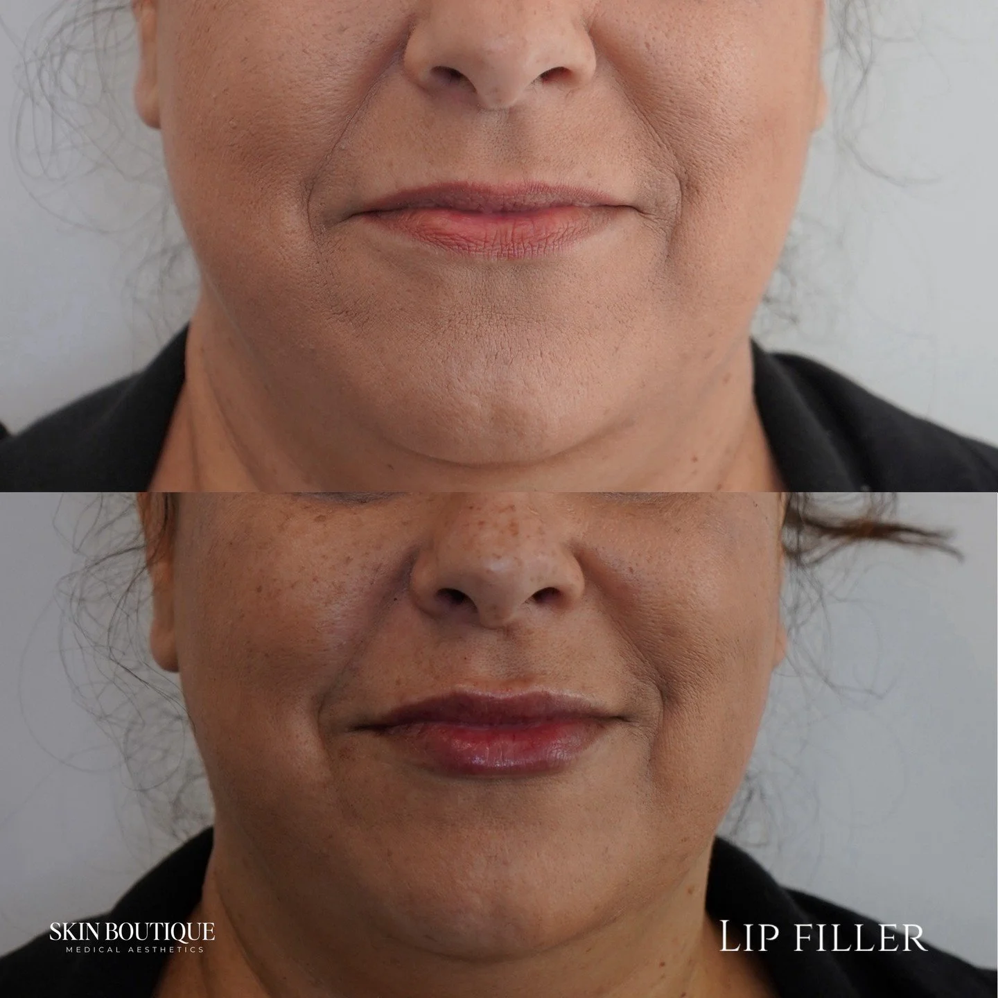 If you&rsquo;re terrified of looking "ducky," this one&rsquo;s for you. ✋🕊️

At Skin Boutique, we don&rsquo;t do "sausage lips." We do sophisticated, high-end restoration. This patient&rsquo;s goal was simple: hydration, a crisp 