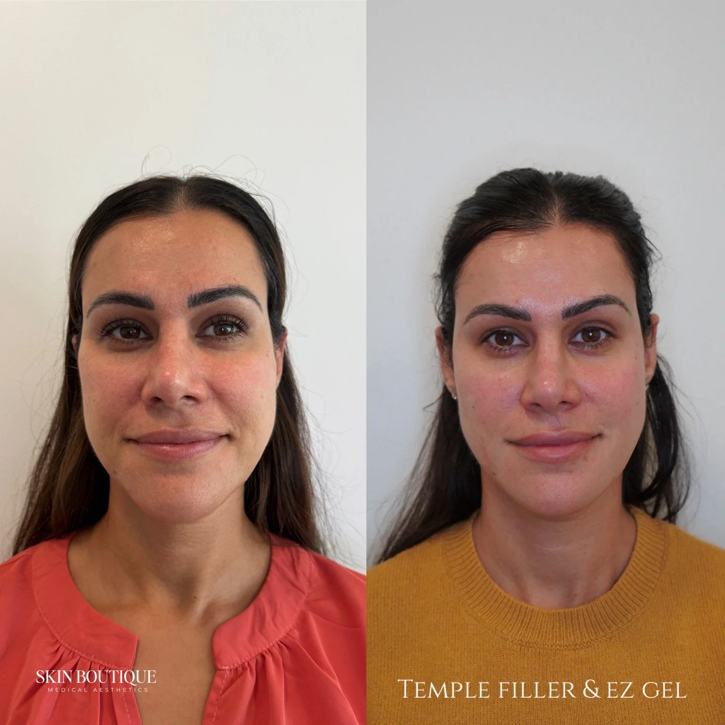 If you feel like you&rsquo;re looking "tired" or "hollow" despite getting enough sleep, the secret might be in your temples. 🕊️

As we age, we lose volume in the upper face, creating a "peanut-shaped" head goal that mak