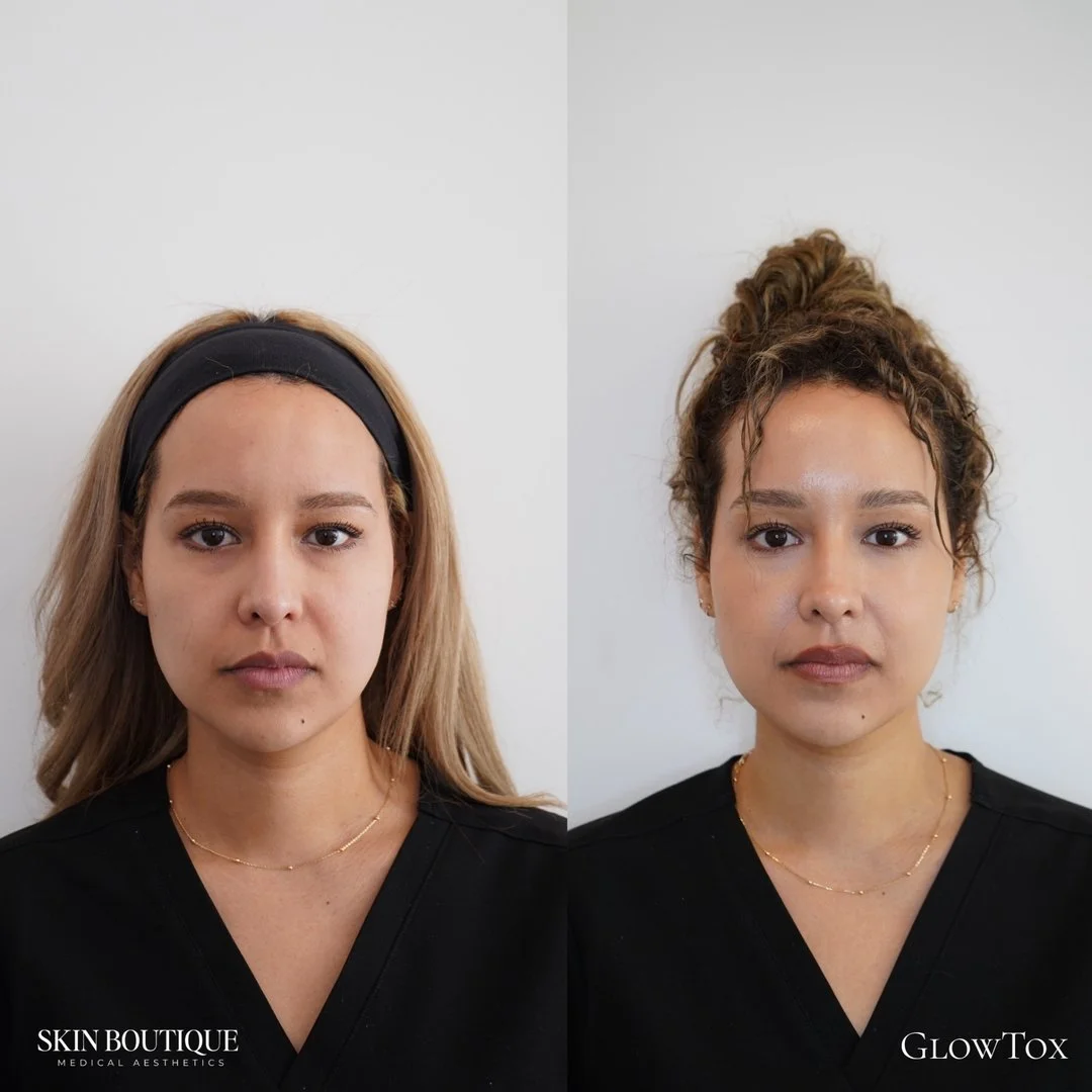 Sara, our Patient Coordinator, finally got her Glow Tox treatment&hellip; and OBSESSED is an understatement ✨​​​​​​​​
​​​​​​​​
Glow Tox = Botox treatment + VI Peel​​​​​​​​
​​​​​​​​
This is one of the Skin Boutique's iconic combos for the go-getter th