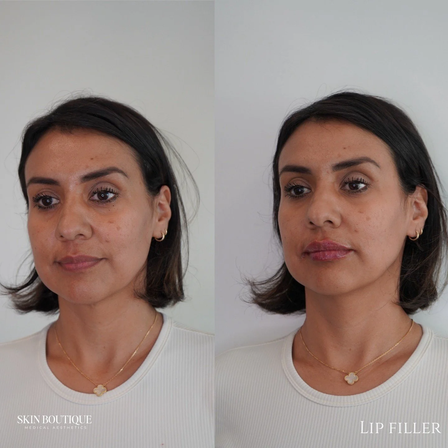 This is what we mean when we say undetectable injectables, you look like you, just better! She asked for natural-looking lips&hellip;Skin Boutique's got her 🤍✨

No overfilling. No &ldquo;done&rdquo; look. Just soft, hydrated, perfectly balanced lips