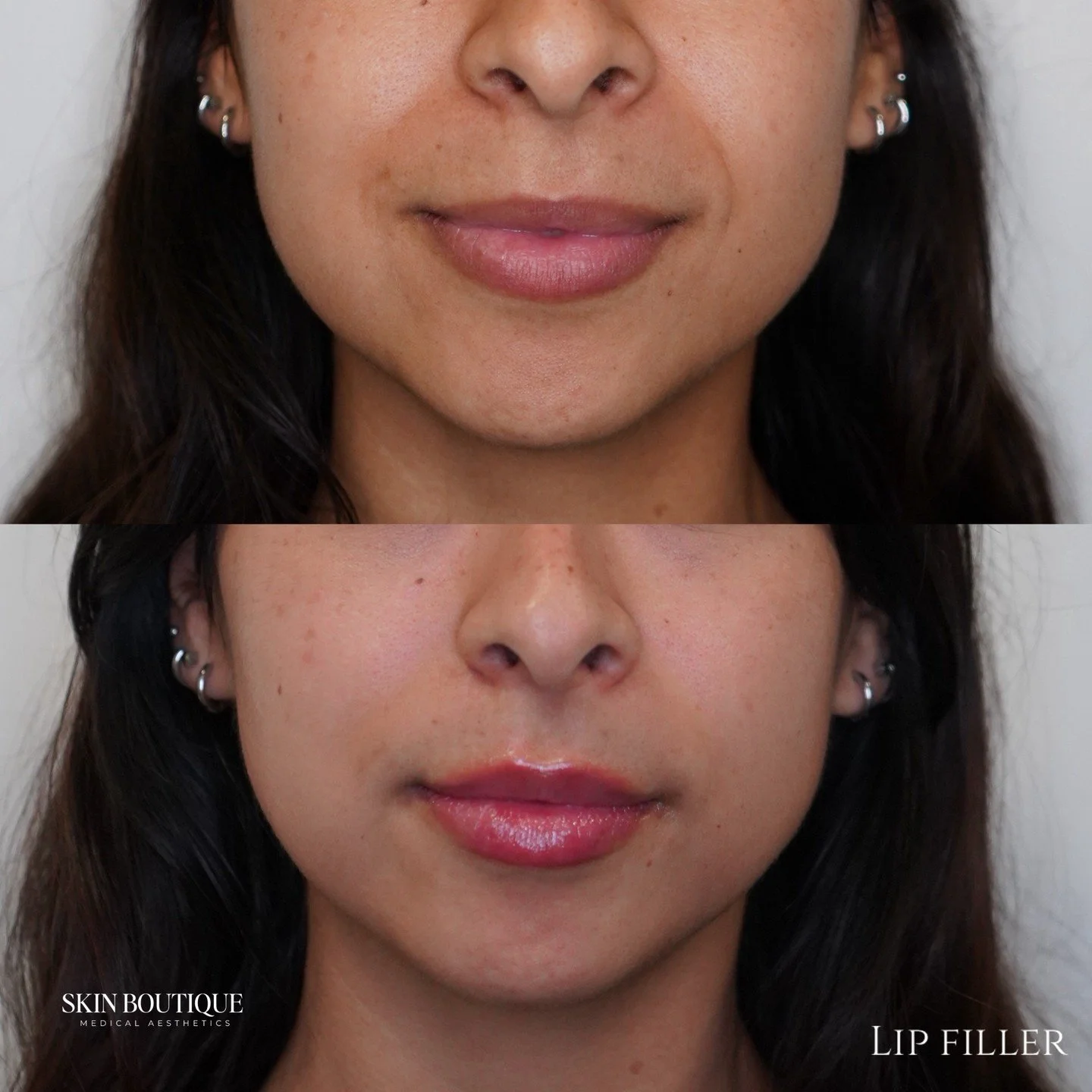 Overfilled and migrated lips are out. Natural, balanced lips are in!!

At Skin Boutique, we focus on definition and hydration&mdash;not volume for the sake of volume. It&rsquo;s about enhancing your natural shape, restoring structure, and keeping eve