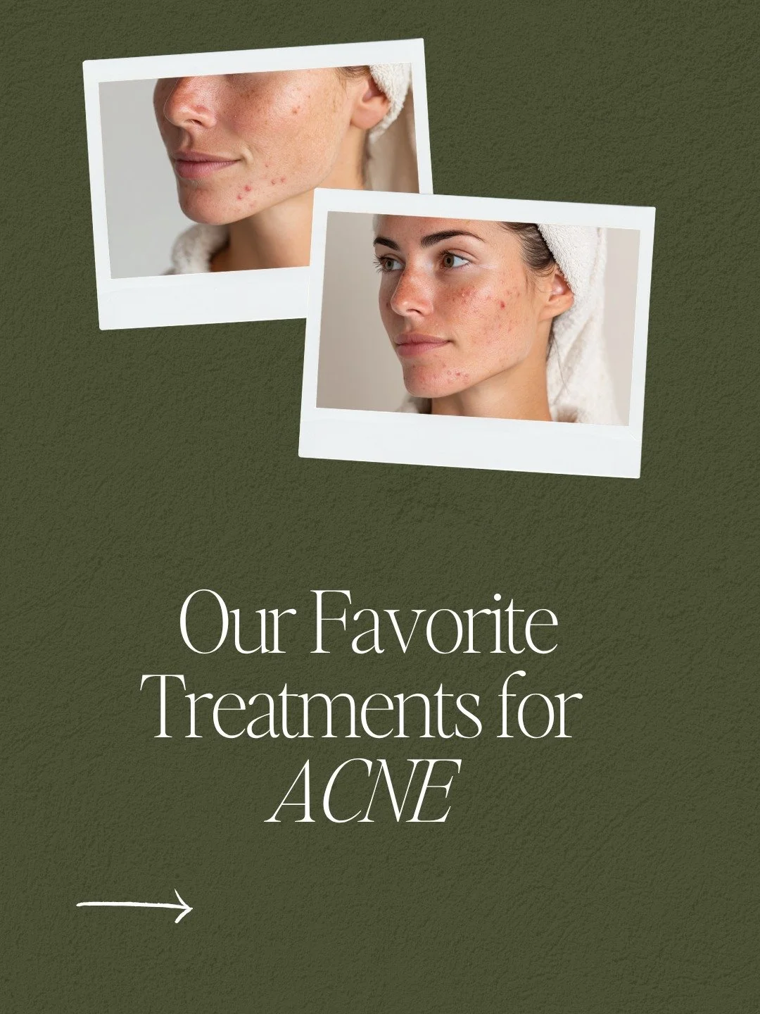 Clear skin isn&rsquo;t luck&mdash;it&rsquo;s a strategy.
Acne treatment is never just one appointment. It&rsquo;s consistency, the right combination of treatments, and a skincare routine that actually supports your skin barrier. 

At Skin Boutique, w