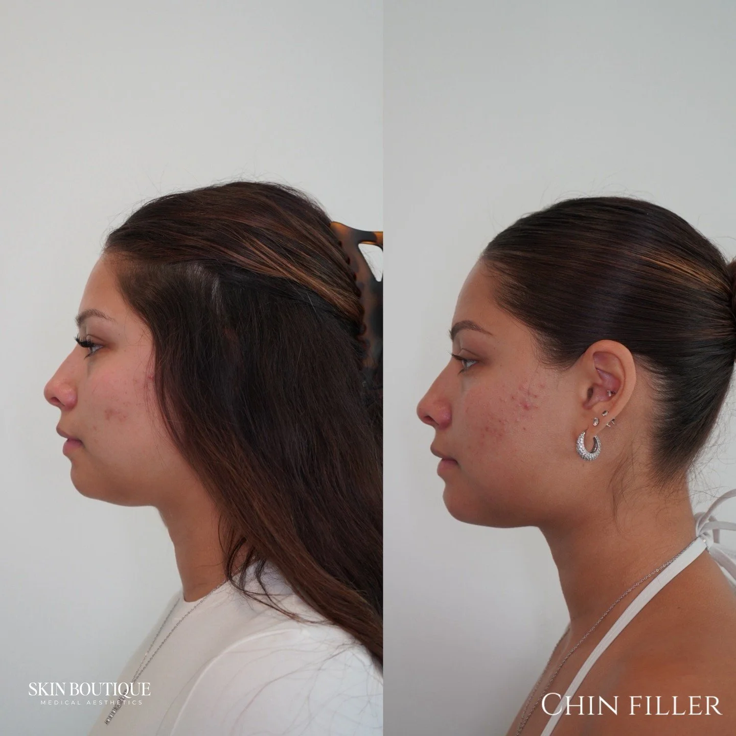If you&rsquo;ve ever felt unsure about filler: this is your sign to rethink what it can look like with the Skin Boutique. This isn&rsquo;t about changing your face. It&rsquo;s about creating balance.

✨ Book a consultation to see what&rsquo;s possibl