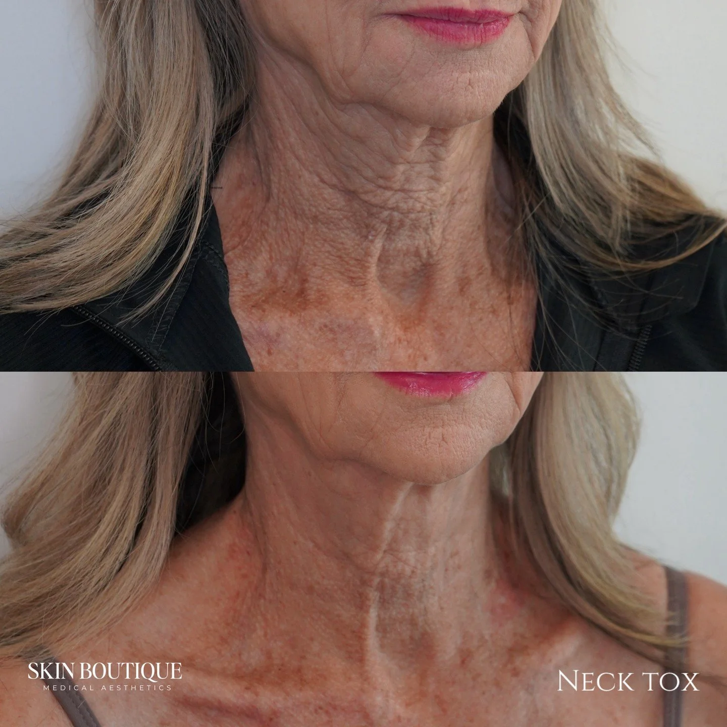 These photos are about 2 weeks apart! 
This is exactly why I&rsquo;ve been recommending the Nefertiti neck tox treatment to everyone lately&hellip;

It&rsquo;s not just about that subtle jawline lift&mdash;it also helps improve skin quality and gives