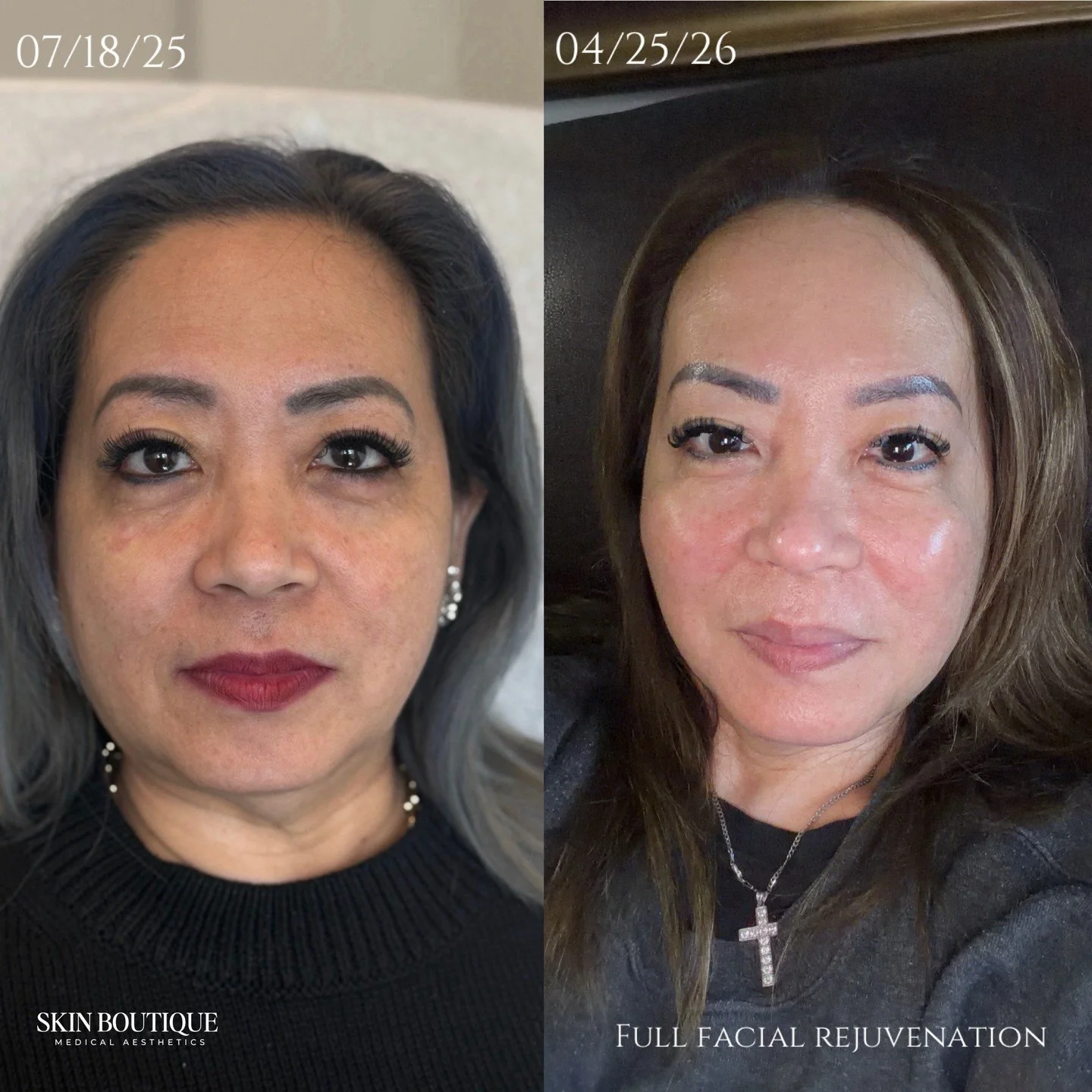 Trusting the process + following a customized treatment plan = the best results ✨

Natural results don&rsquo;t happen overnight. It&rsquo;s all about consistency, collagen stimulation, skin quality, and treating the face as a whole 🤍

Small changes 