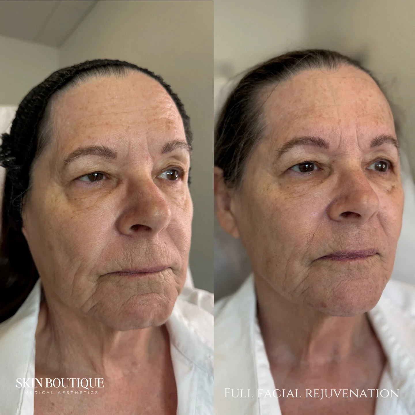 These photos are about 6 weeks apart ✨

This beautiful patient is actually a candidate for surgical intervention, but after a very honest conversation about realistic expectations, goals, and options&hellip; we created a customized treatment plan foc