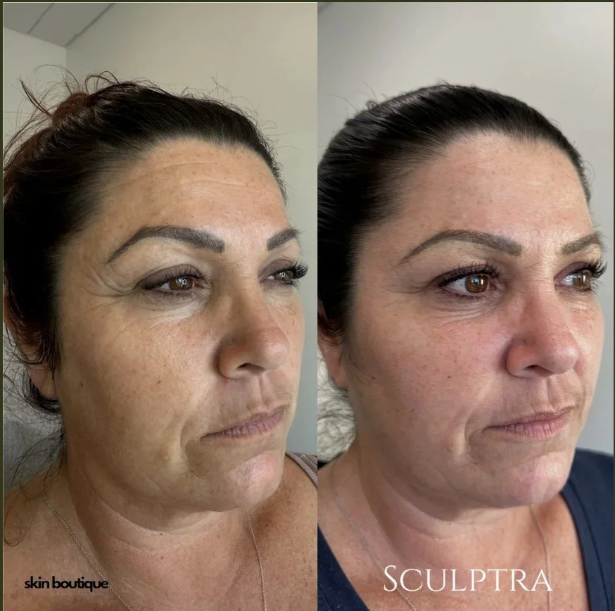 Benefits of Sculptra Treatment