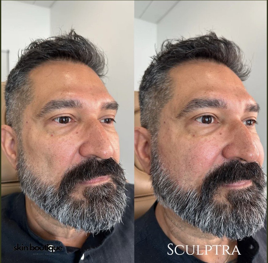 Sculptra vs Other Cosmetic Treatments