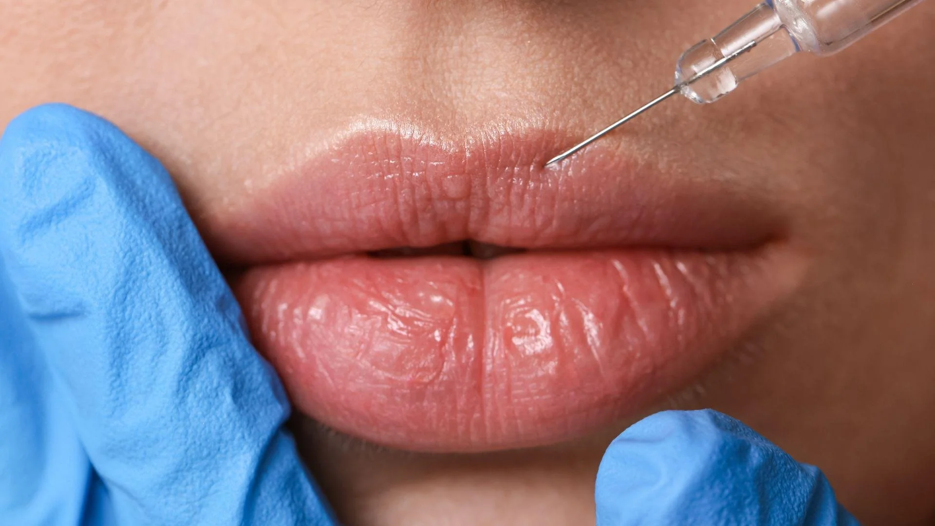 How Long Do Lip Fillers Last and How That Affects Cost