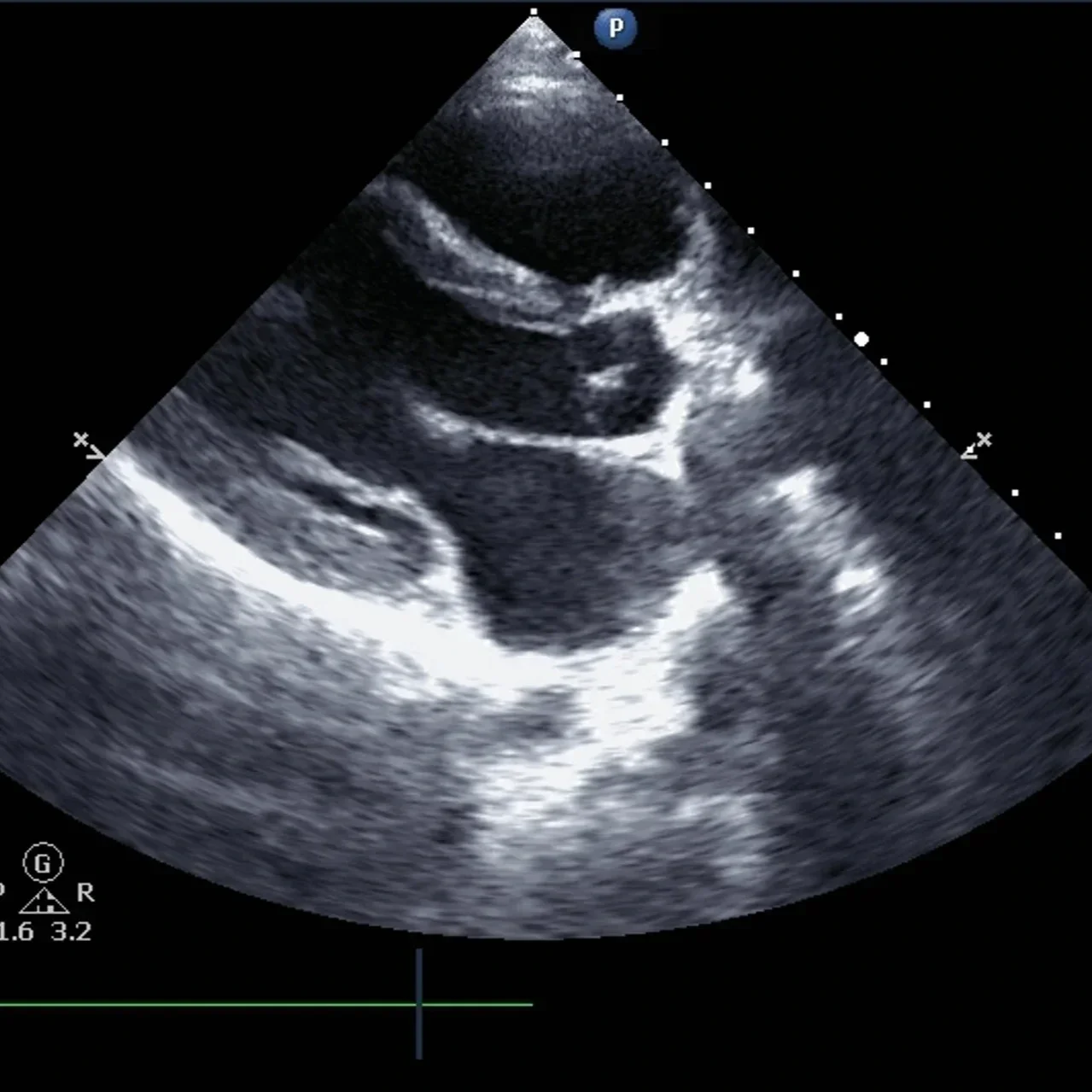 What an Echocardiogram Can Reveal About Heart Health
