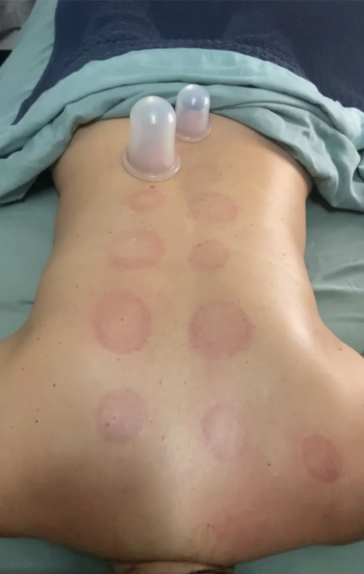 Cupping marks for back pain