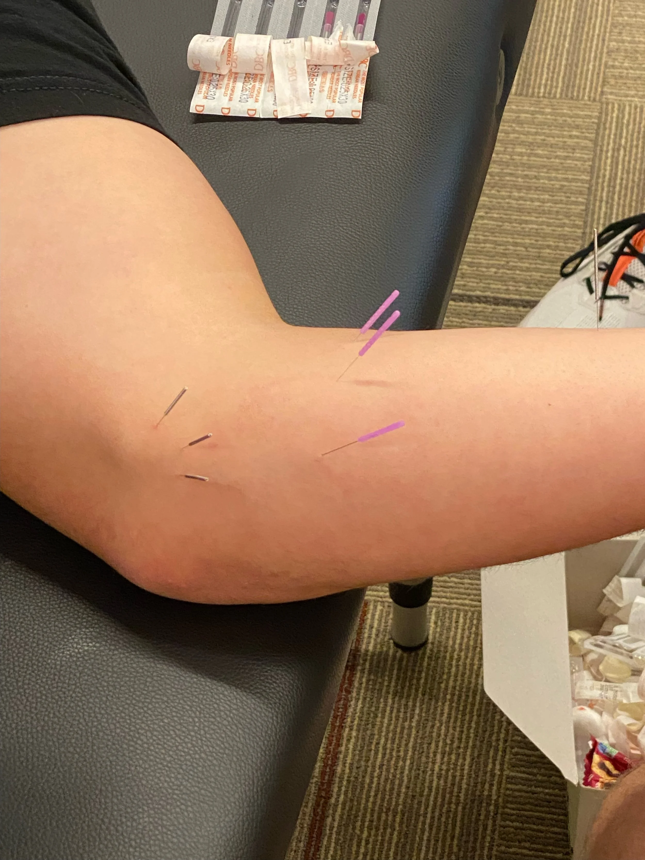 Dry needling.JPEG