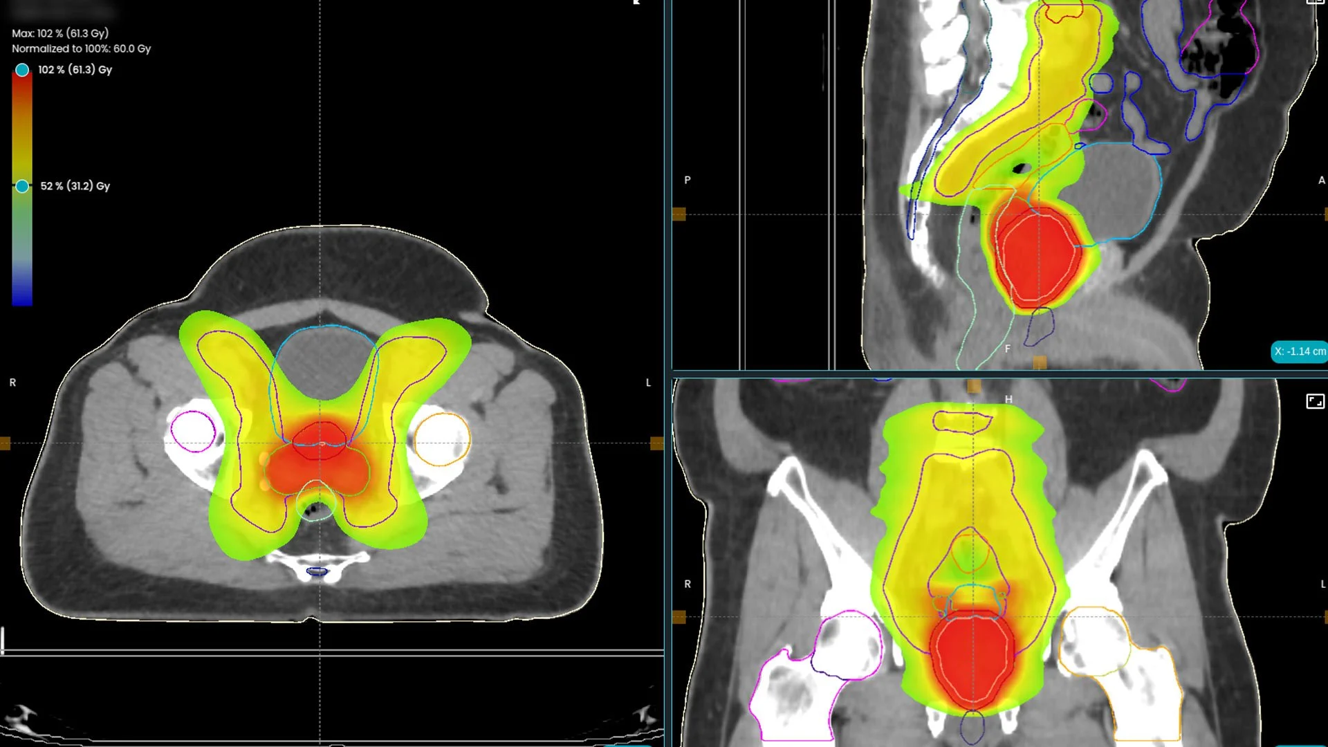 MVision AI - Optimise Prostate &amp; Pelvic RT Planning with AI-Powered Dose+