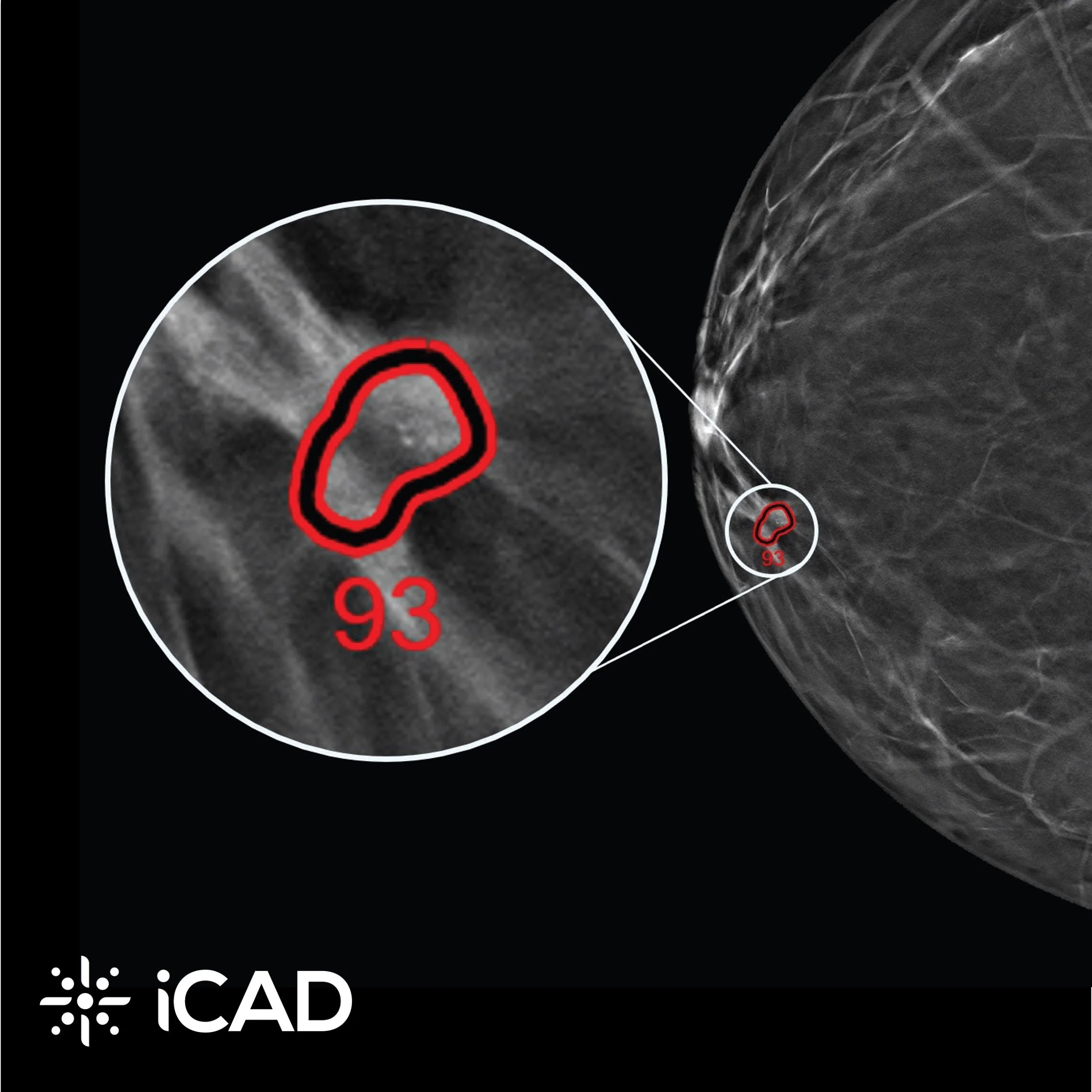 Ein Schwarz-Weiß-Bild, das einen medizinischen Scan mit roten Markierungen um einen bestimmten Bereich herum zeigt, unten links mit dem iCAD-Logo.