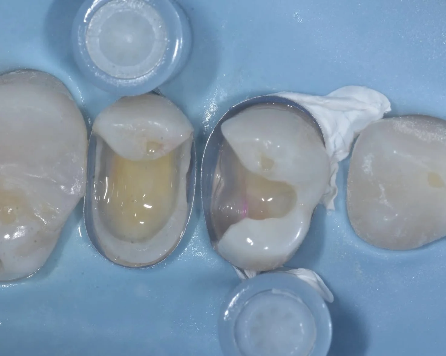 Caries Removal Endpoints (CREs)