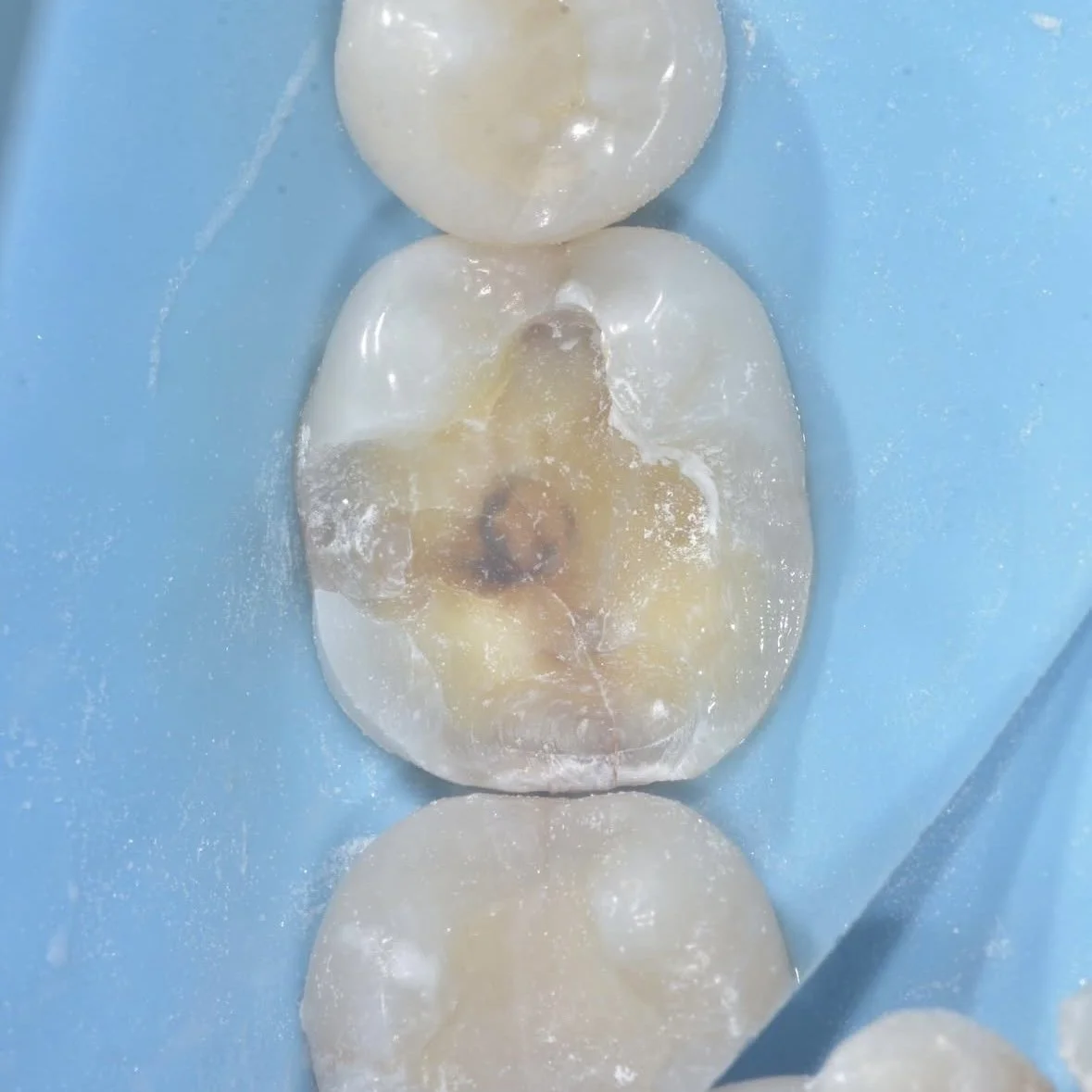 Post-operative Dental Sensitivity: Causes and Treatment