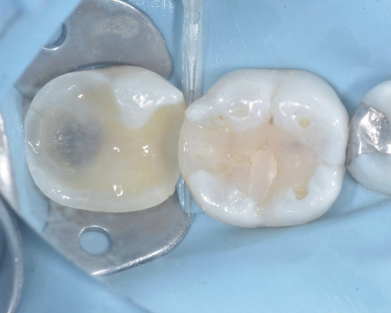 What is a hybrid layer dentistry 5.jpg