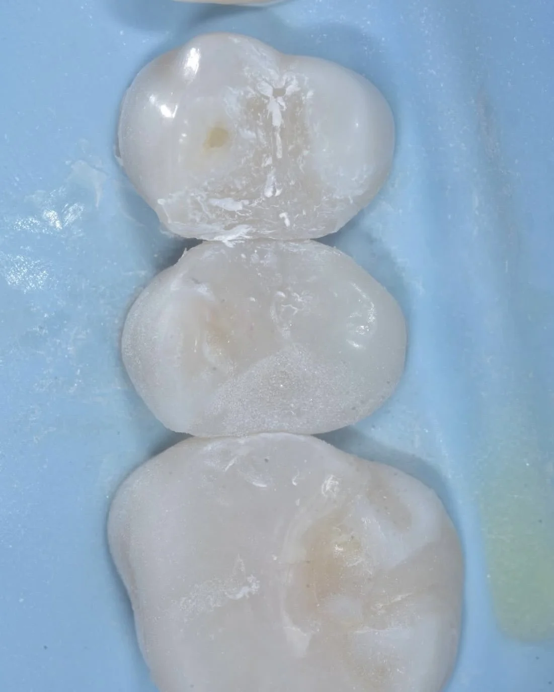 Predictable caries removal case Davey Alleman 7.jpg