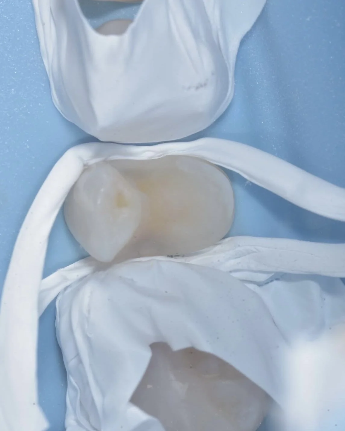 Predictable caries removal case Davey Alleman 5.jpg