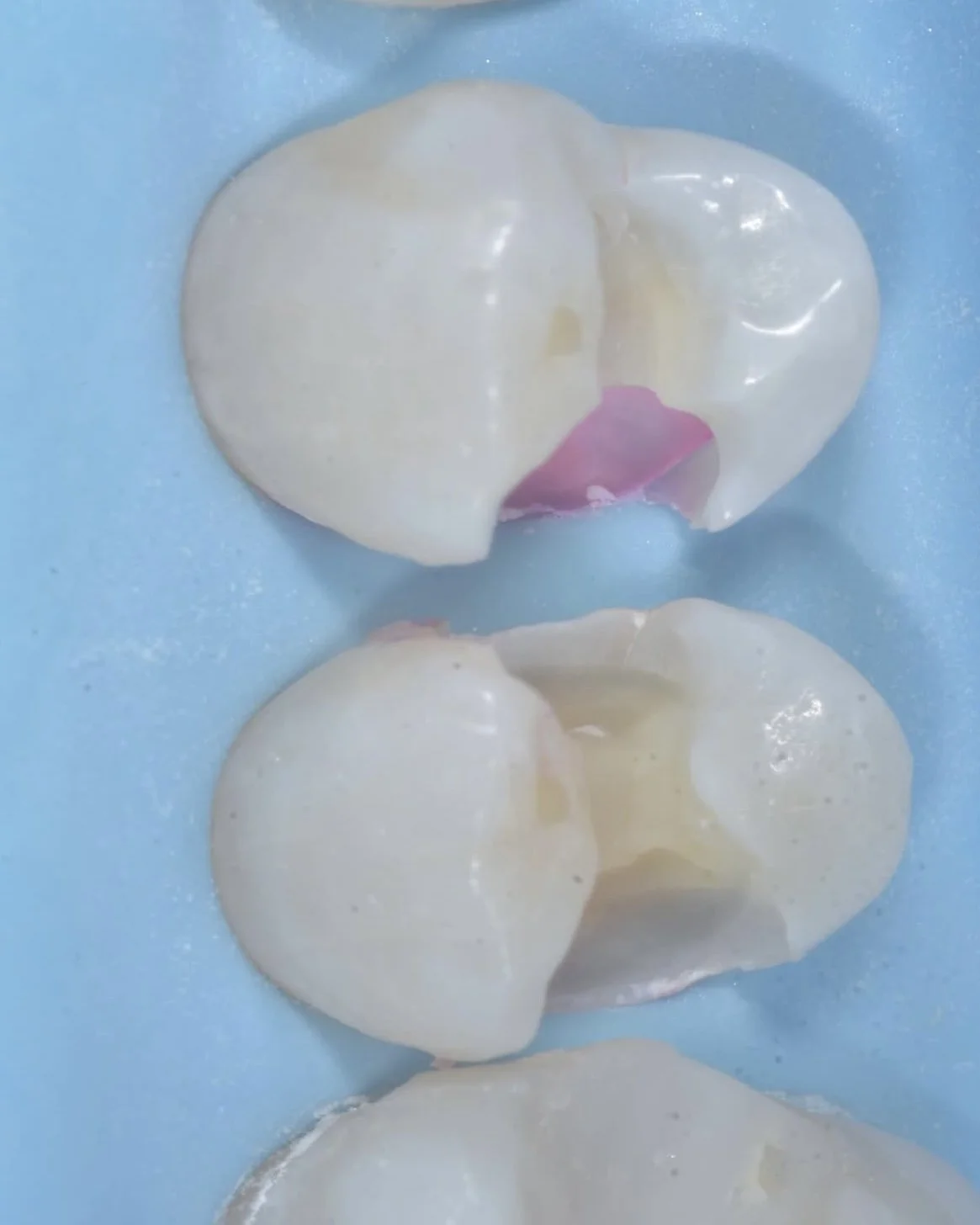 Predictable caries removal case Davey Alleman 2.jpg