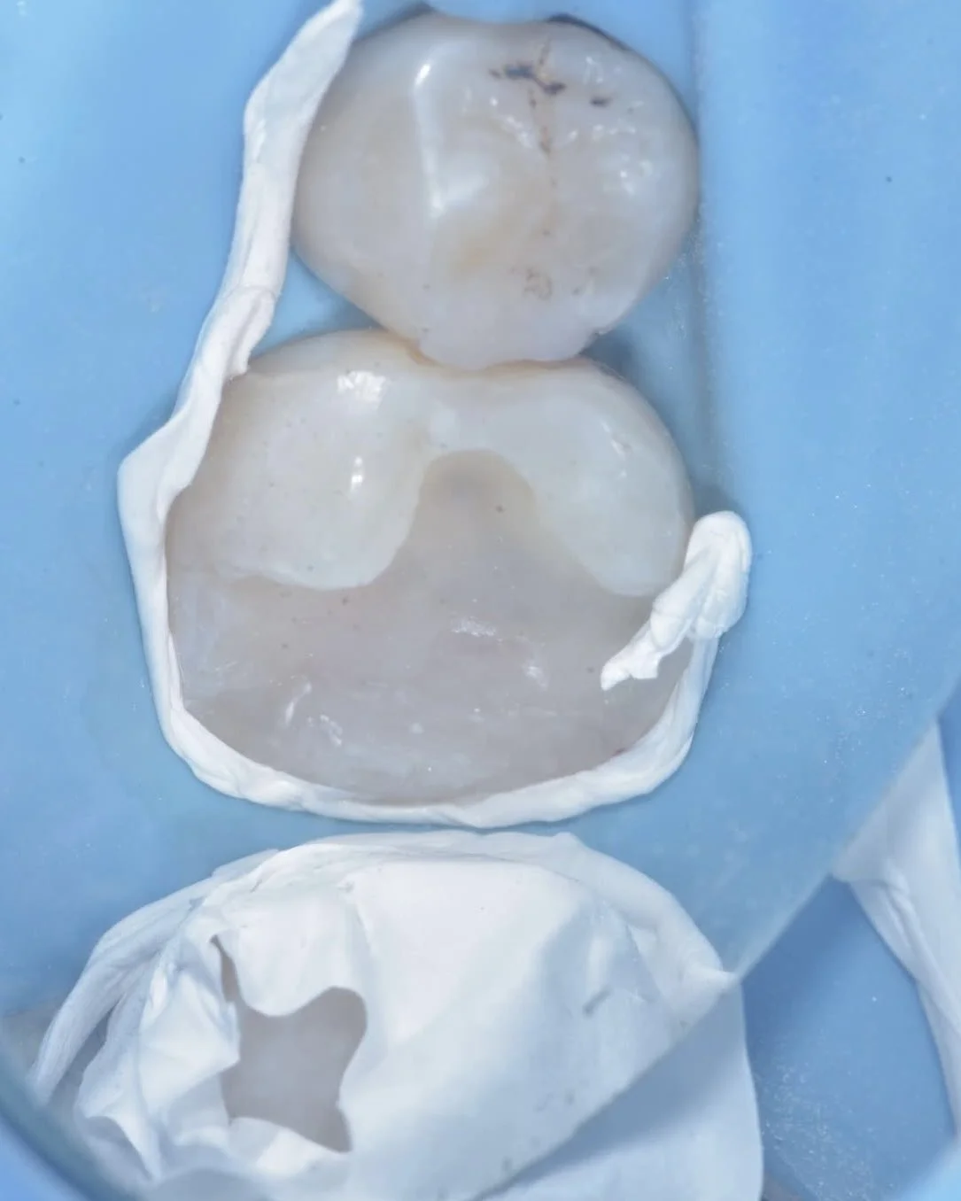 Caries removal endpoints case Davey Alleman 7.jpg