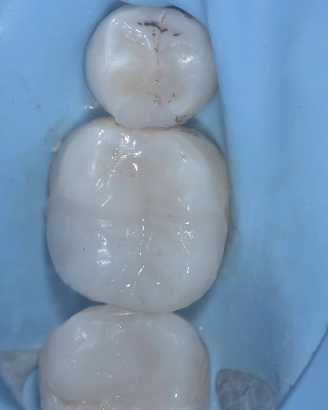 Caries removal endpoints case Davey Alleman 8.jpg