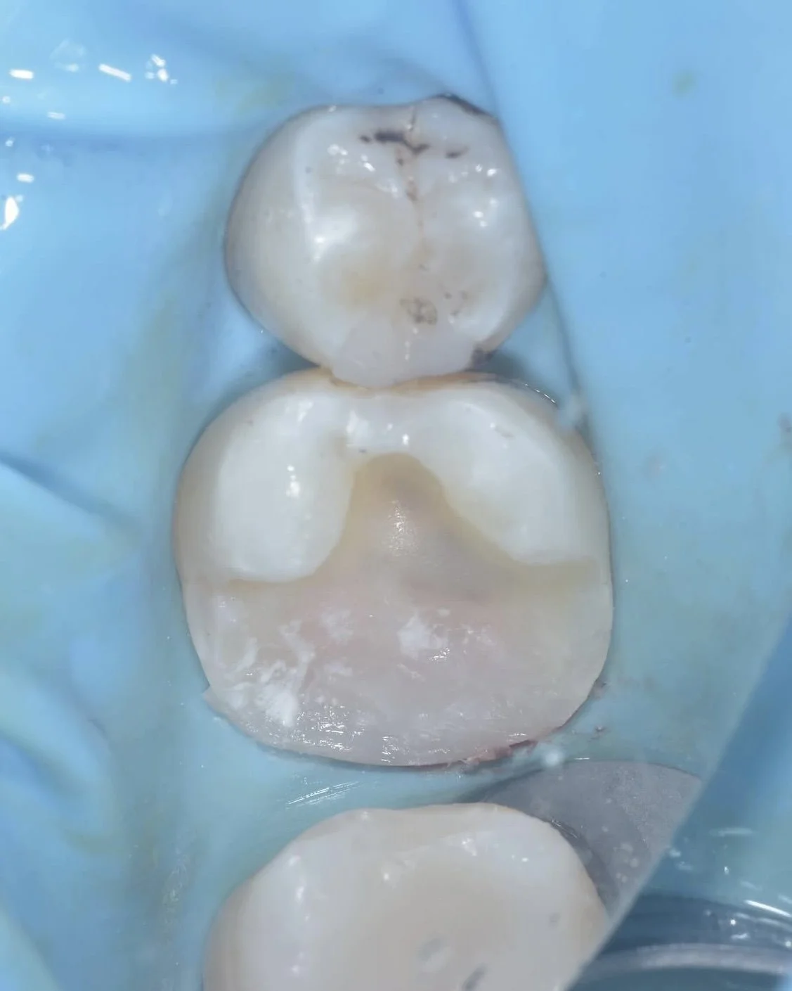 Caries removal endpoints case Davey Alleman 6.jpg
