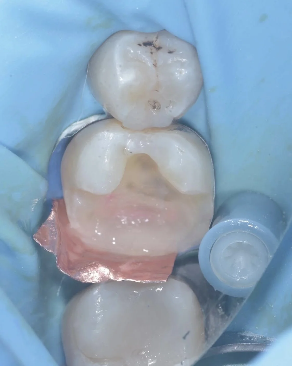 Caries removal endpoints case Davey Alleman 5.jpg