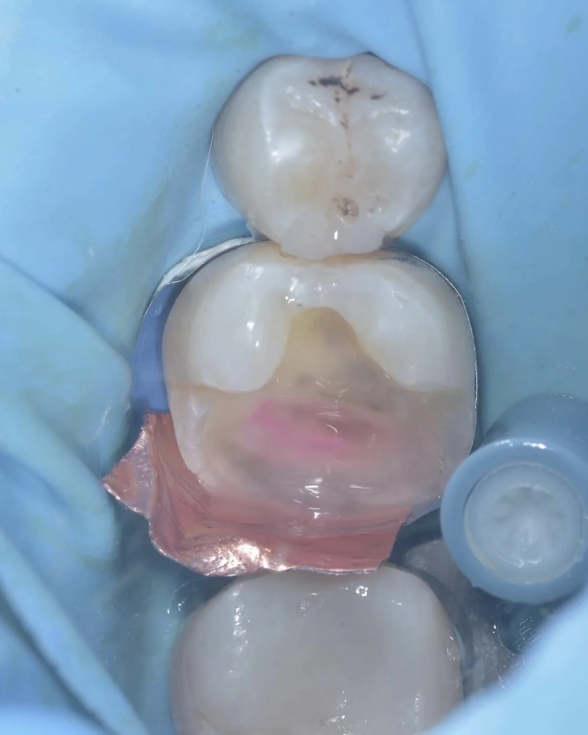 Caries removal endpoints case Davey Alleman 4.jpg
