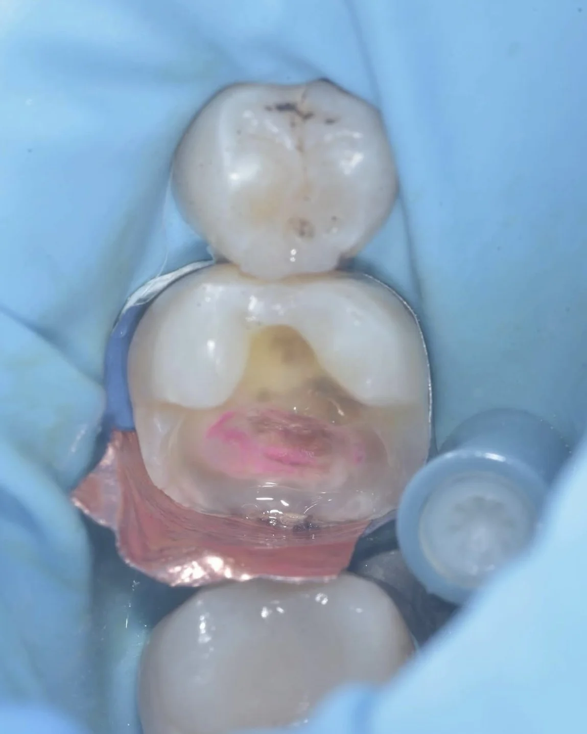 Caries removal endpoints case Davey Alleman 3.jpg